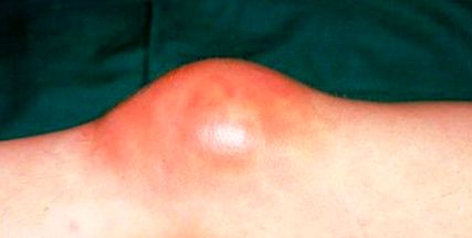 peroxid arthrosis kezelés térd ízületi izomfájdalom tünetei
