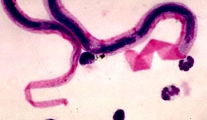 kerekféreg tünetei és a kerekféreg kerekféreg kezelése hogyan kezeli a pinwormokat