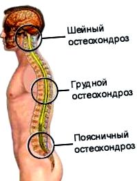nyaki mellkasi ágyéki osteochondrosis)