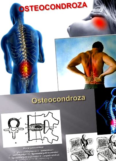 a nyaki és a mellkasi osteochondrosis kezelése)