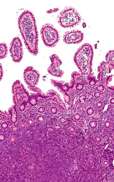 Az aszcariasis teszt klinikai tünetei Paraziták a testkezelésben Trichinosis biohelminthiasis