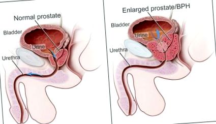 prostatitis és vérrák