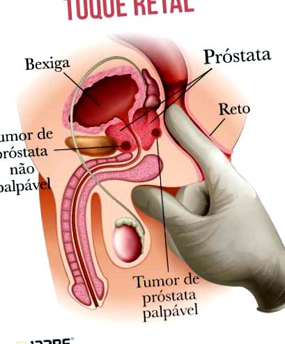 A prosztatamegnagyobbodás tünetei és következményei - Prostatitis kezdeti jelek