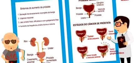 cancer prostate gleason 7 43