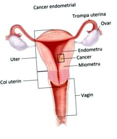 endometrium rák hisztopatológia mellbimbó condyloma