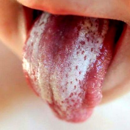 OTSZ Online - Szisztémás betegségek szájüregi tünetei