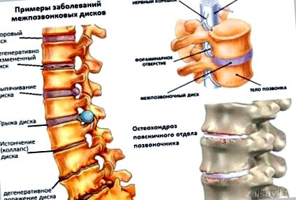 Az osteochondrosis típusai: leírás, tünetek és kezelési jellemzők
