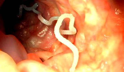 Enterobiosis tünetei és kezelése felnőtteknél, pinworms felnőtt tünetek. Oxyurosis (Enterobiosis)
