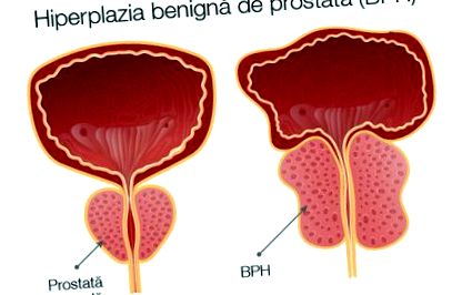 DGPG a prostatitis háttérén. A jóindulatú prosztata hiperplázia tünetei