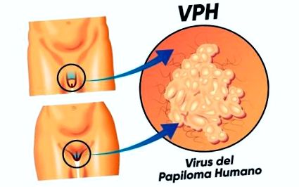 Human Papilloma Vírus – a HPV