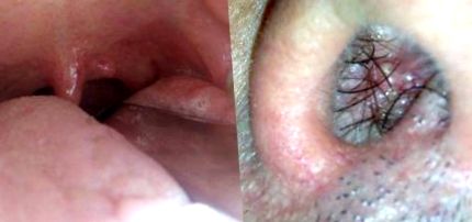 Papilloma dell ugola intervento - Recept a papilloma kezelésére