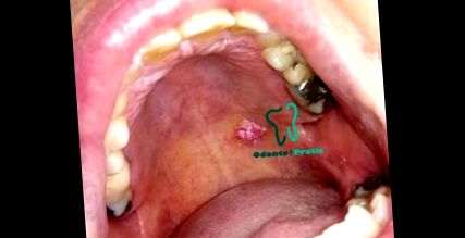 Hogyan diagnosztizáljuk a torokrákot - Pikkelyes papilloma uvula patológia