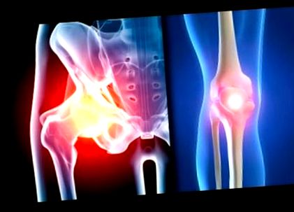 Deformáló térd osteoarthrosis 4 fokos kezelés