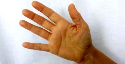 kéz- és lábízületi fájdalom kezelése