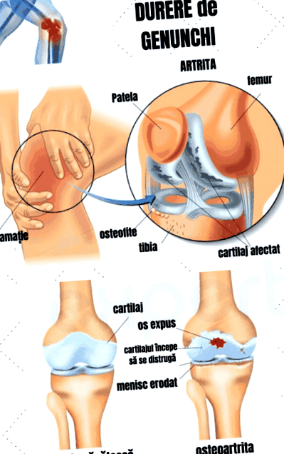 Fájdalomcsillapítás: ha a csont és az ízület fáj - HáziPatika, Melegítő kenőcs a térdízületre