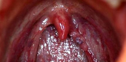 emberi papillomavírus a szájban