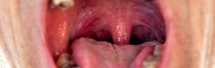 Nőknek és férfiaknak is fontos odafigyelni a HPV okozta tünetekre! | Uránia Medical Center