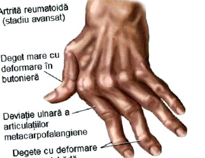 rheumatoid arthritis ízületi kezelés