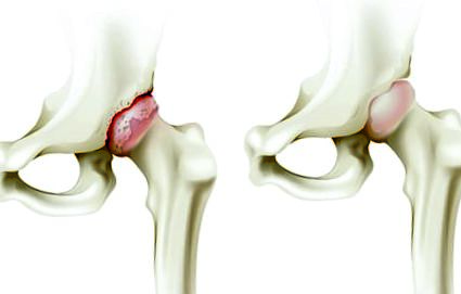 A bal csípőízület deformáló artrózisa 2 fokkal, Mi az arthrózis?