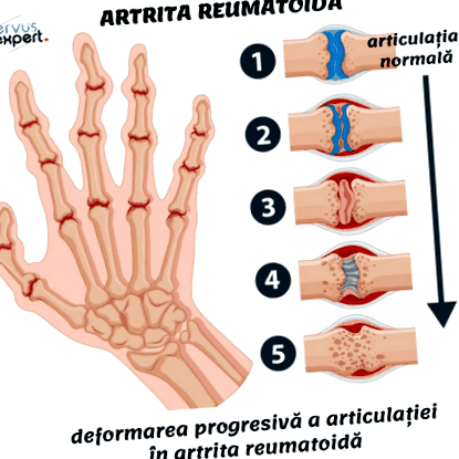 artritisz duzzadt ujjak