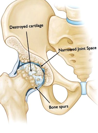 csont elmozdulás fájdalma a csípőízületben fájdalom a térdben és az alsó lábban