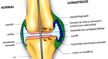 a perifériás ízületek és a gerinc osteoarthritis a térdízület deformáló arthrosisa