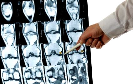 Gonartrosis a térd 2 fokos gyógyszeres kezelés, Térd osteoarthritis — tünetek, kezelés otthon