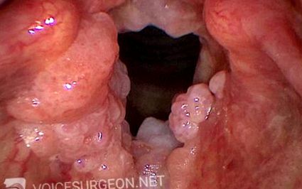 Mellkasi papilloma. A HPV-fertőzés tünetei nőkben és férfiakban