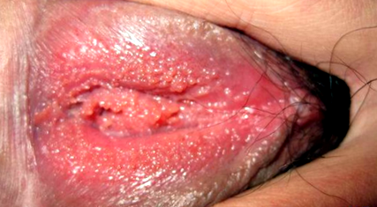 Penyakit hpv laki laki - Yang dimaksud humán papilloma vírus