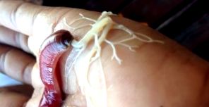 Az emberi bőr parazitáinak tünetei és kezelése Emberi bőr paraziták képei