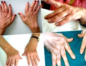 a hüvelykujj artritisz súlyosbodása