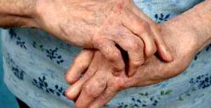 arthritis csukló kézkezelés)