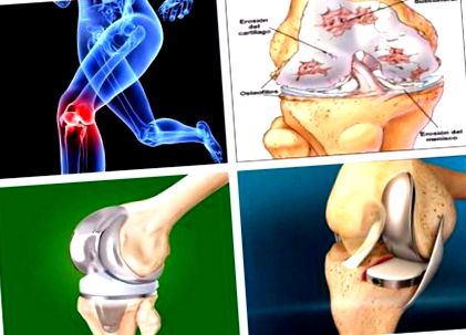éles térdfájdalom hajlításkor ízületi deformáció rheumatoid arthritisben