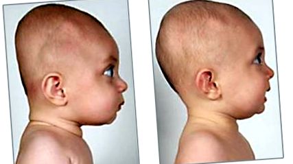 Mi a plagiocephalia vagy a lapított fej szindróma csecsemőknél