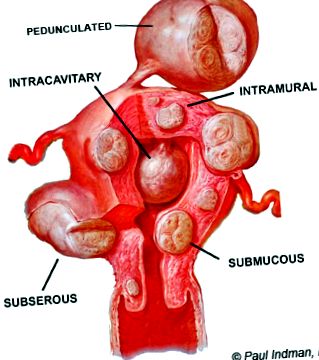 fibroidy