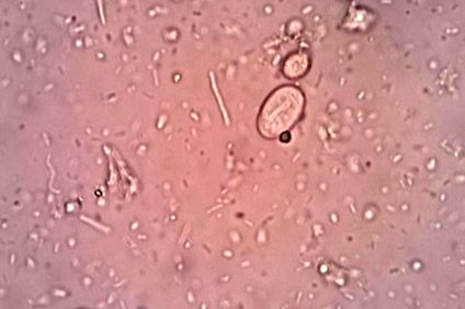 Pinworms és giardia lamblia, A fertőzés fertőzés tünetei a gyermekekben. Enterobiasis kezelése
