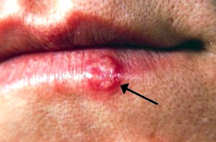 Akut anális és nemi szemölcsök - HPV fertőzés