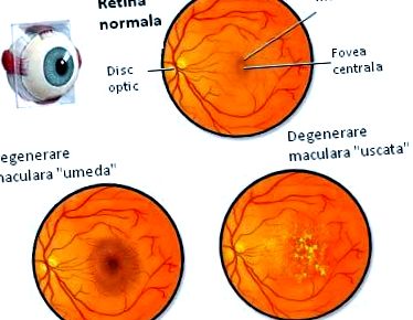 Myopia és makula degeneráció Myopia és makula degeneráció