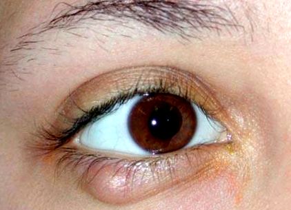 Árpa a szemen, hogyan kell kezelni a szemész - Mi az árpa a szemekben