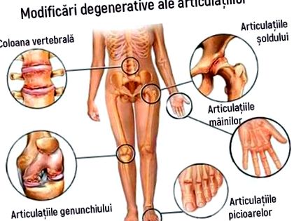 Hogyan lehet helyreállítani az ízületet artrózissal