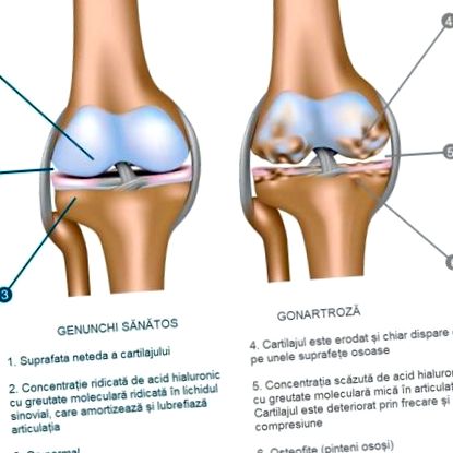 A rheumatoid arthritis - Sarok osteoarthritis kezelés