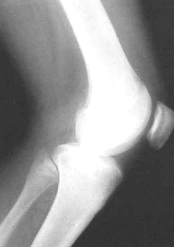 A bokaízület deformáló artrózisa 3. fokozatú kezelés Térdízület betegségei