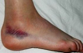 Bokaszalag sérülés: bokaszalag szakadás