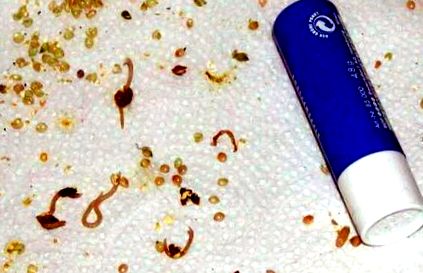 Féregtojás a gyermek ürülékében Parazitatojások a székletben Pinworms - bélparaziták