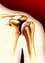 A vállízület deformáló artrózisa 4 fokkal Ízületi folyadék a könyökízület kezelésében