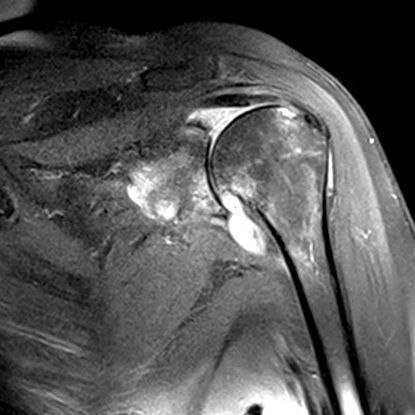 elsődleges osteoarthritis