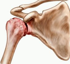 deformáló osteoarthritis a vállízület kezelése clavicularis-brachialis arthrosis