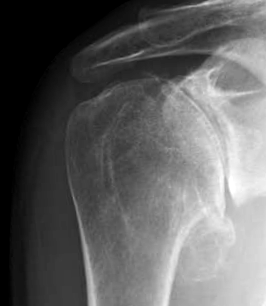 deformáló osteoarthritis a vállízület kezelése