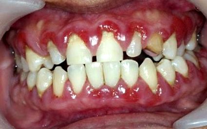 periodontális betegség diabetes kezelésben szenvedő betegeknél