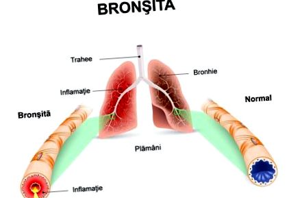 bronchitis kezelés során a diabetes